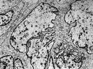 M,5y. | rhabdomyosarcoma vestibuli oris M,5y. | rhabdomyosarcoma vestibuli oris